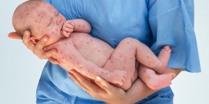 Eruption cutanee et fievre de bebe : 3 causes possibles