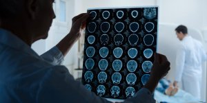 Anevrisme cerebral non rompu : que faire ?
