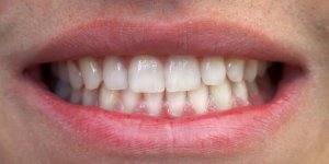 Les femmes ayant perdu des dents sont plus a risque d’hypertension arterielle