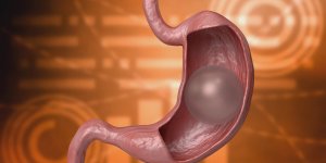Ballon gastrique : quelles conditions pour en beneficier ? 
