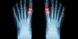 Arthrose du pied : la crise de goutte a l-orteil