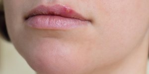 Bouton de fievre : la propolis peut-elle le faire disparaitre plus vite ?