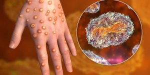 Variole du singe : comment se faire tester du virus Monkeypox ? 