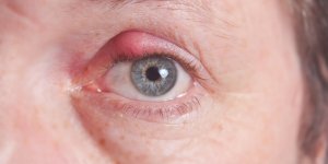 Chalazion de la paupiere : la definition