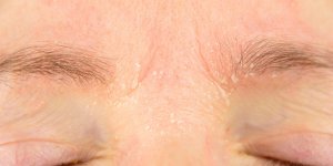 Eczema du visage : causes, traitements et comment eviter les crises ?