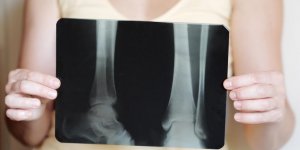 Osteoporose : c-est quoi la demineralisation osseuse ?