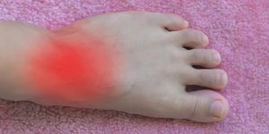 Goutte : reconnaitre une crise de goutte au pied
