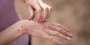 Maladies de peau et intestins : les liens se resserrent
