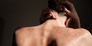 Lamotrigine : l-ANSM alerte sur le risque d’eruption cutanee grave de ce medicament