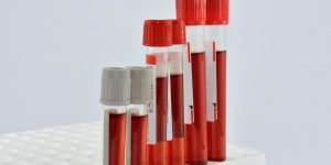 Hypertriglyceridemie : les risques lies a un taux trop eleve