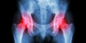 L-arthrose de la hanche apres 60 ans