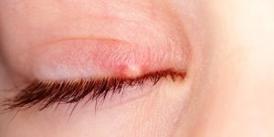 Orgelet, chalazion, conjonctivite : comment les reconnaitre ?