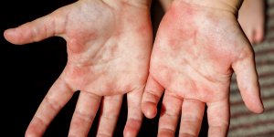 Scarlatine : quelle est son origine ?