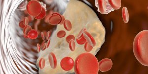 Atherosclerose et infarctus du myocarde : le lien
