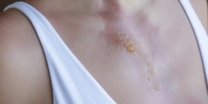 Faut-il percer une cloque de brulure ?