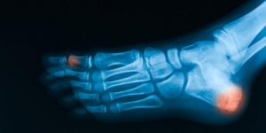 Scintigraphie osseuse du pied : comment cela se passe ?