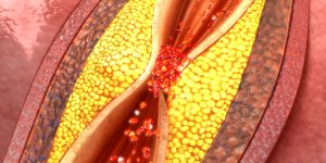 Cholesterol : un facteur de risque d-atherosclerose ?