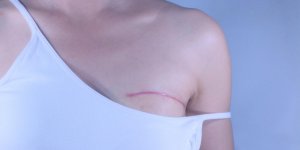 Cancer du sein : la convalescence apres une ablation mammaire