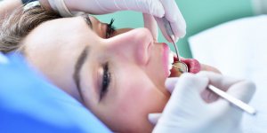 Tartre sous-gingival : la technique de surfacage