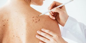 Cancer de la peau : comment le distinguer d-une eruption cutanee