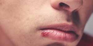 La duree de contagion d-un bouton de fievre