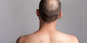 6 astuces pour camoufler une calvitie
