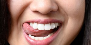 Mycose a la langue : peut-on l-attraper avec un baiser ?