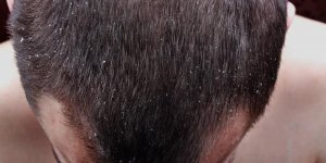 Une solution contre les cheveux gras chez l-homme