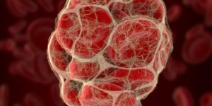 Embolie pulmonaire : le traitement anticoagulant