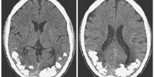 Des cailloux de calcium dans son cerveau a l’origine de ses migraines