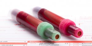Bilan lipidique : a jeun ou pas ?
