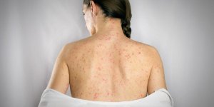Variole du singe (mpox) : 6 conseils pour limiter sa propagation