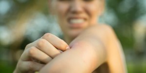 Abeille, tique, araignee… Un pharmacien explique comment savoir quel insecte vous a mordu ou pique