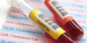 Cholesterol : il peut annoncer une maladie cardiaque 20 ans avant