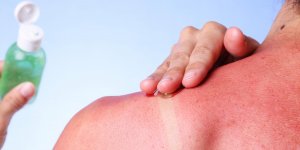 8 remedes naturels anti coup de soleil
