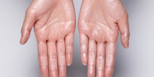 Transpiration des pieds et des mains : connaissez-vous l-ionophorese ? Cette technique est ultra efficace !