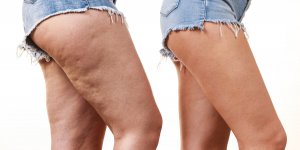 Cellulite : 5 astuces naturelles pour la reduire