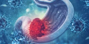 Cancer de l-estomac : quels sont les facteurs de risque evitables ?