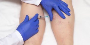 Traitement des varices : 8 effets indesirables a surveiller, selon l-ANSM