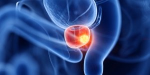 Cancer de la prostate : pourquoi le depistage organise n’est-il pas mis en place ?