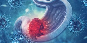 Cancer de l-estomac : 8 signes qui apparaissent precocement 