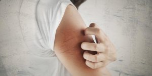 Piqures de moustiques : ce qu-il ne faut surtout pas faire !