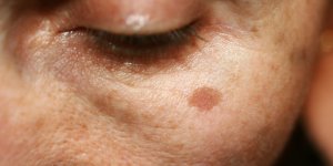 Taches brunes : 6 solutions naturelles pour les eliminer