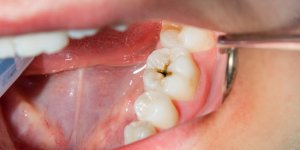 Caries : 10 aliments qui les favorisent