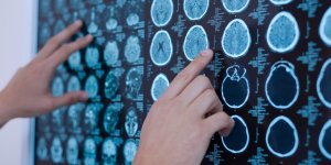 9 stars qui ont eu une tumeur au cerveau