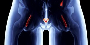 Cancer de la prostate : zoom sur l-examen TEP-choline