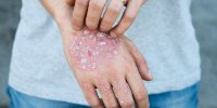 Psoriasis : symptômes, causes, diagnostic et traitements