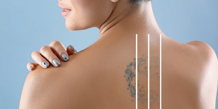 Detatouage laser : 10 stars qui ont fait enlever leur tatouage