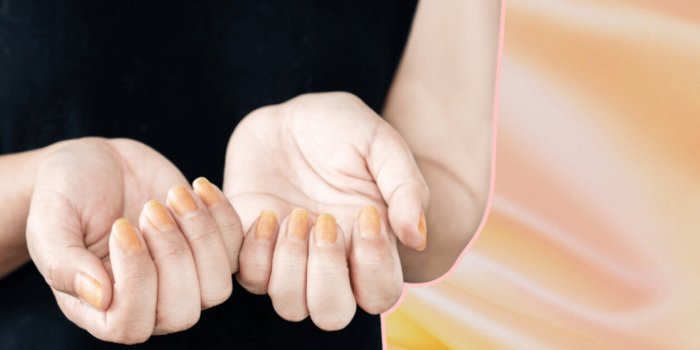 Ongles jaunes : 7 causes possibles et comment les dejaunir