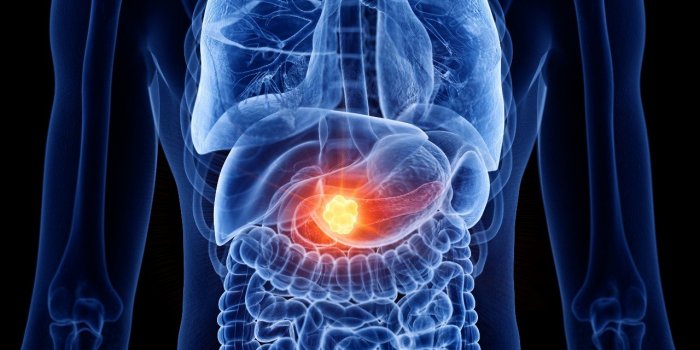Cancer du pancreas : ces 5 sensations dans les jambes peuvent etre un signe